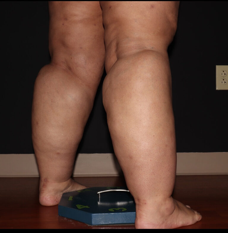 Before Image: Stage 3 - right-back-oblique