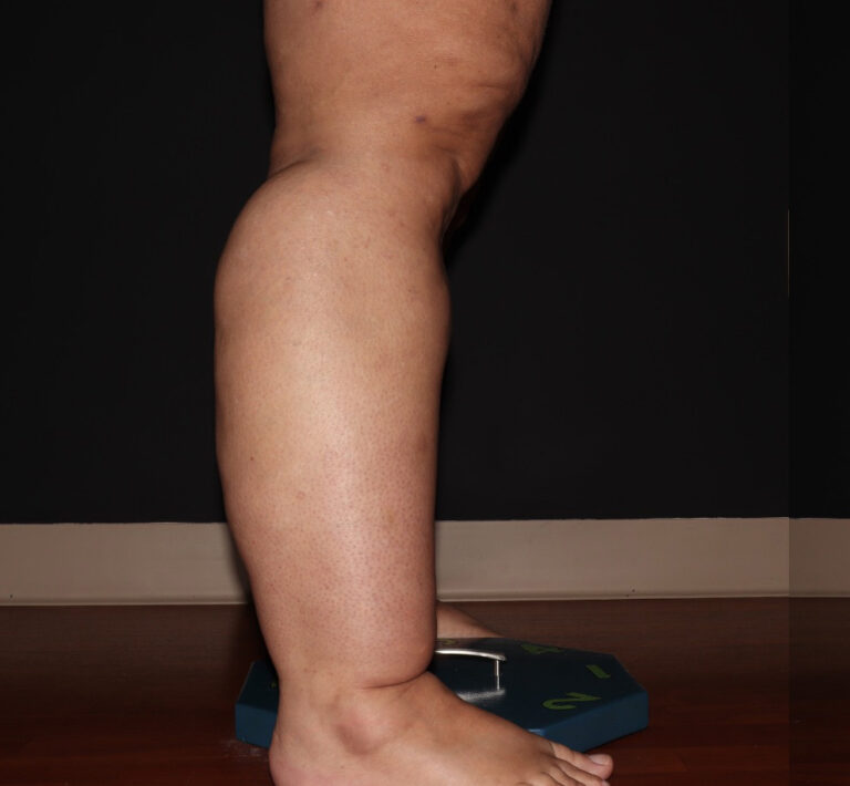 Before Image: Stage 3 - right-side