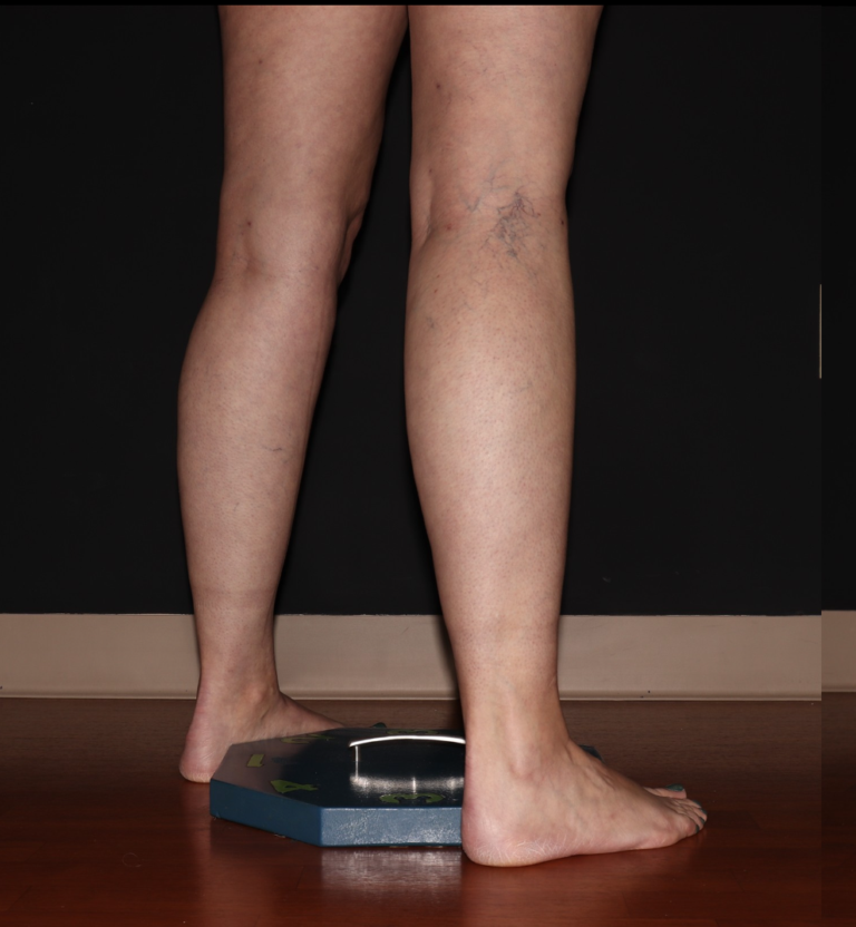 Before Image: Stage 1 - right-back-oblique