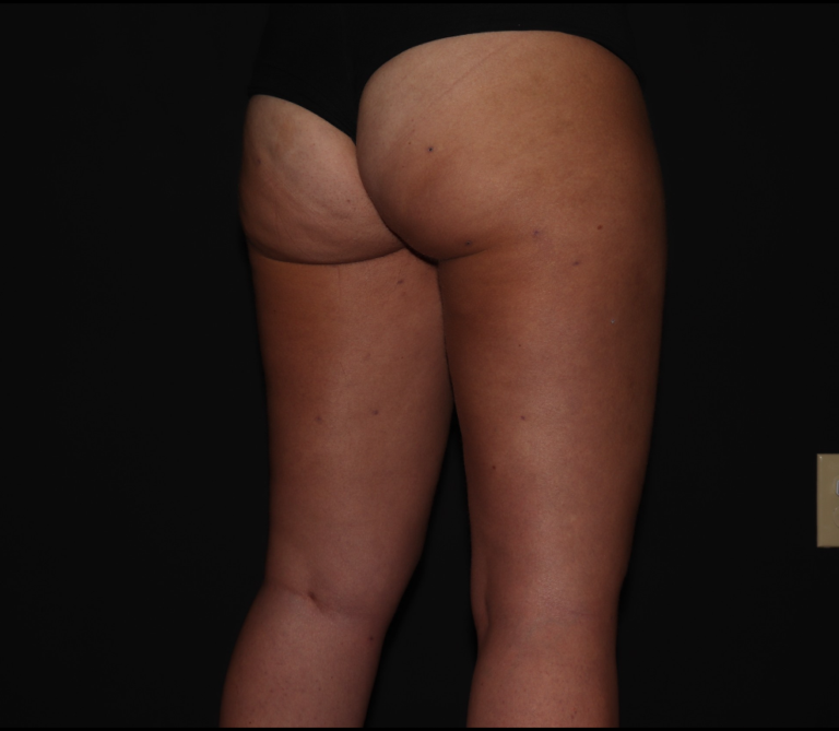 After Image: Stage 1 - right-back-oblique