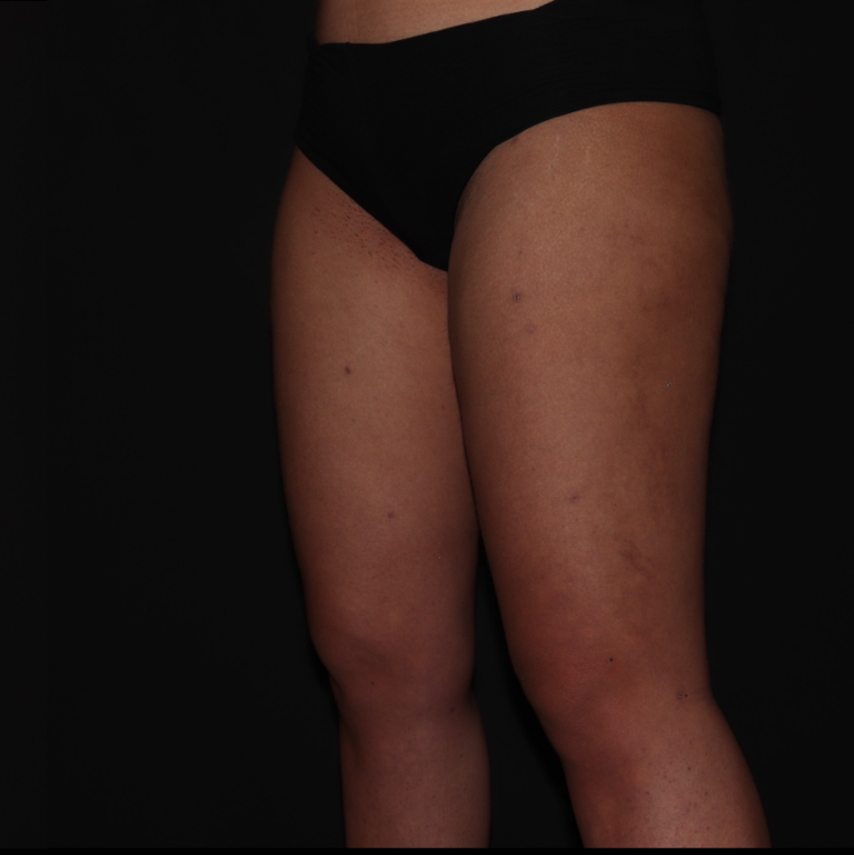 After Image: Stage 1 - left-front-oblique