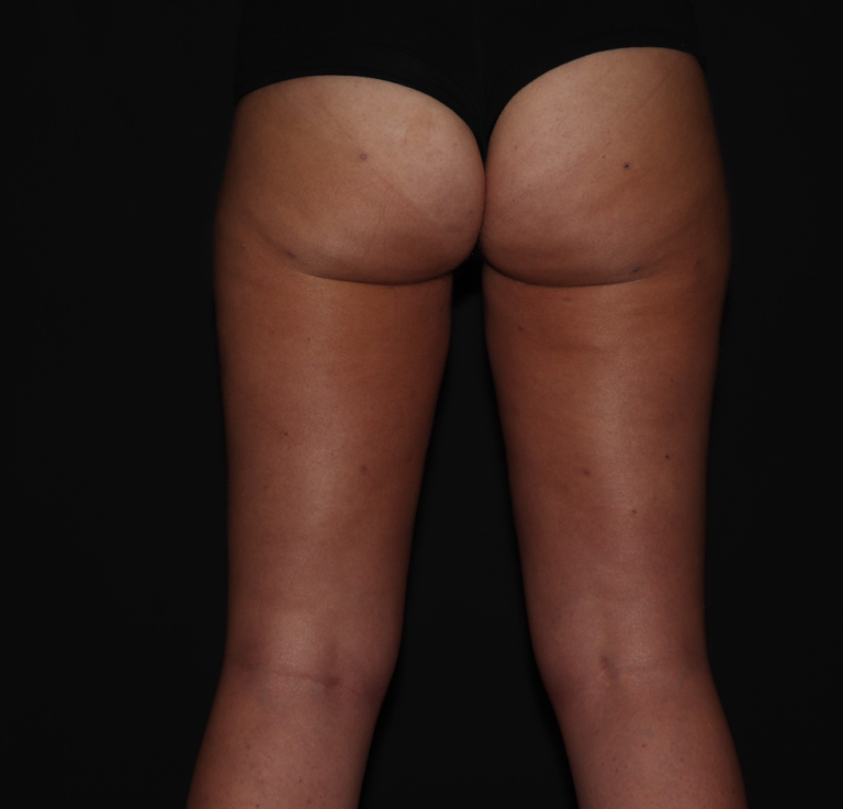After Image: Stage 1 - back