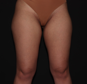 Before Image: Stage 1