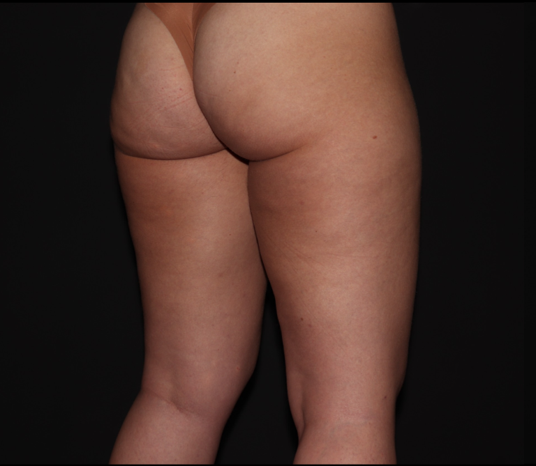 Before Image: Stage 1 - right-back-oblique