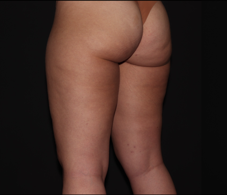 Before Image: Stage 1 - left-back-oblique