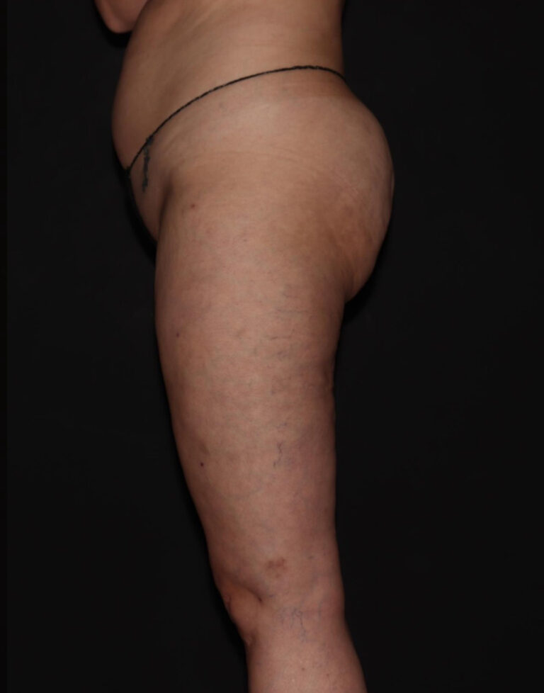 After Image: Stage 1 - left-side