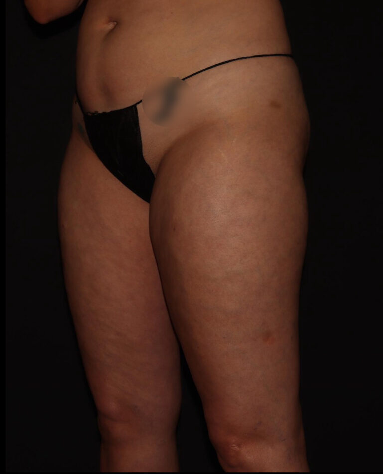 Before Image: Stage 1 - left-front-oblique