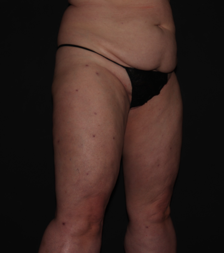 After Image: Stage 2 - right-front-oblique
