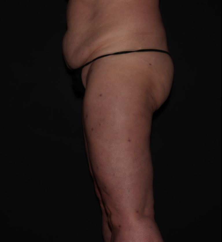 After Image: Stage 2 - left-side