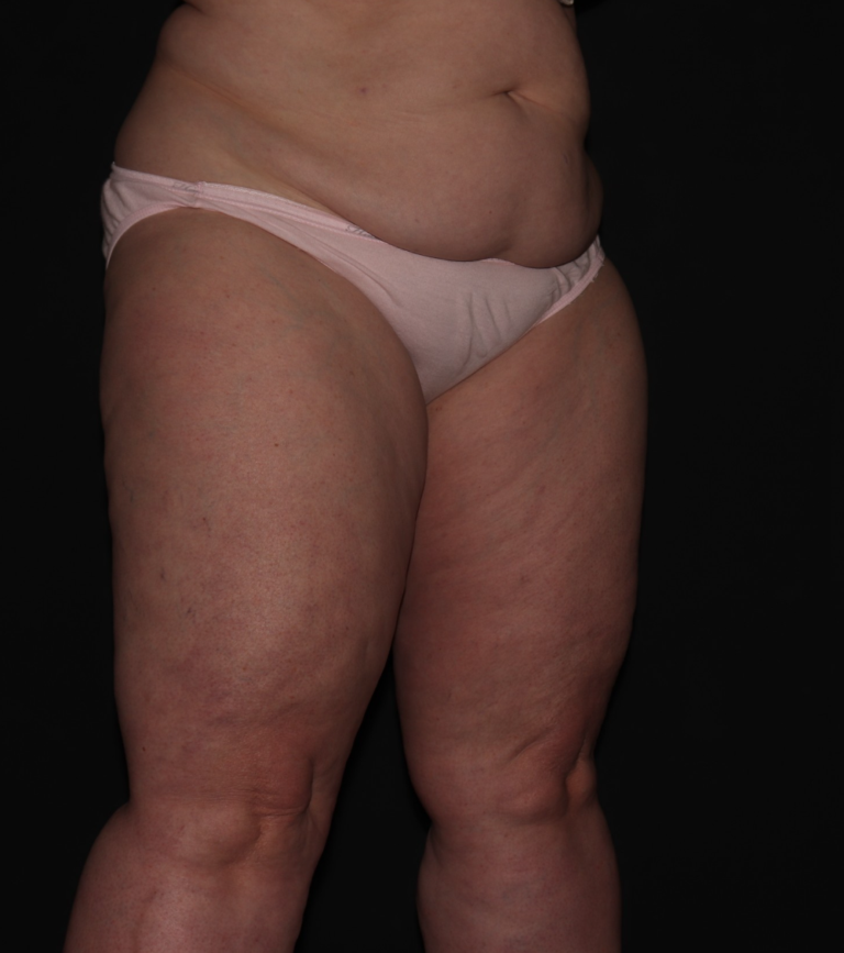 Before Image: Stage 2 - right-front-oblique