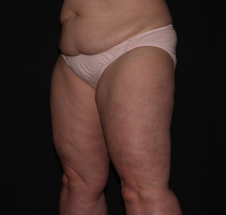 Before Image: Stage 2 - left-front-oblique