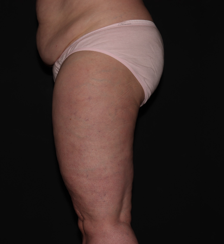 Before Image: Stage 2 - left-side