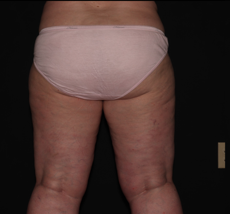 Before Image: Stage 2 - back