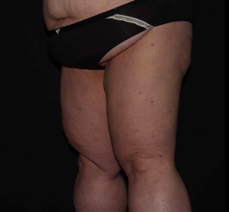 After Image: Stage 3 - left-front-oblique
