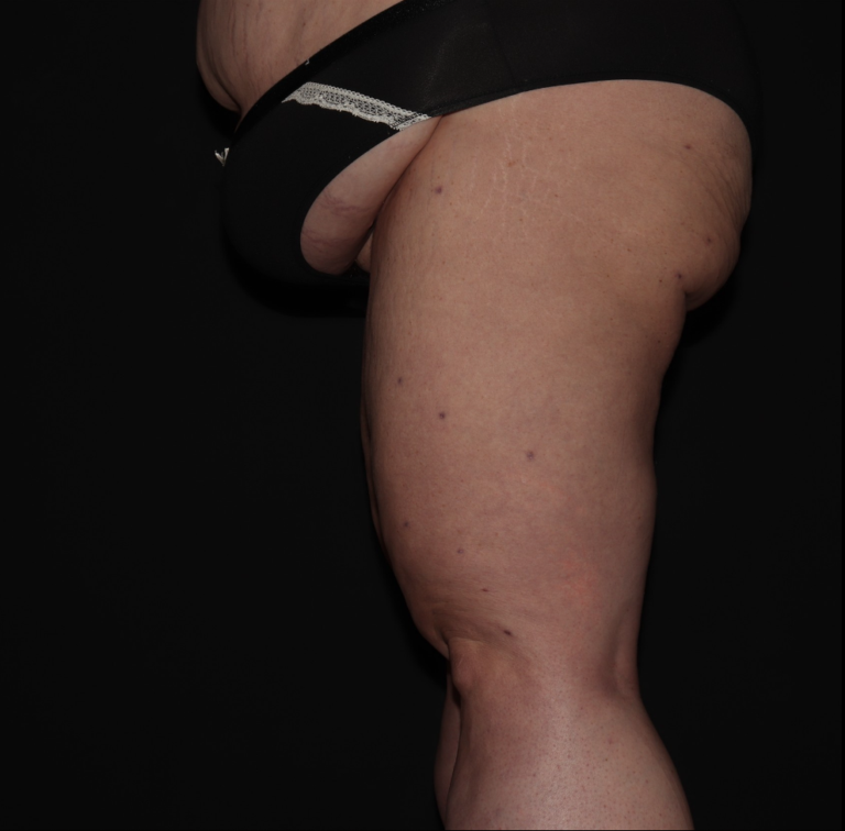 After Image: Stage 3 - left-side