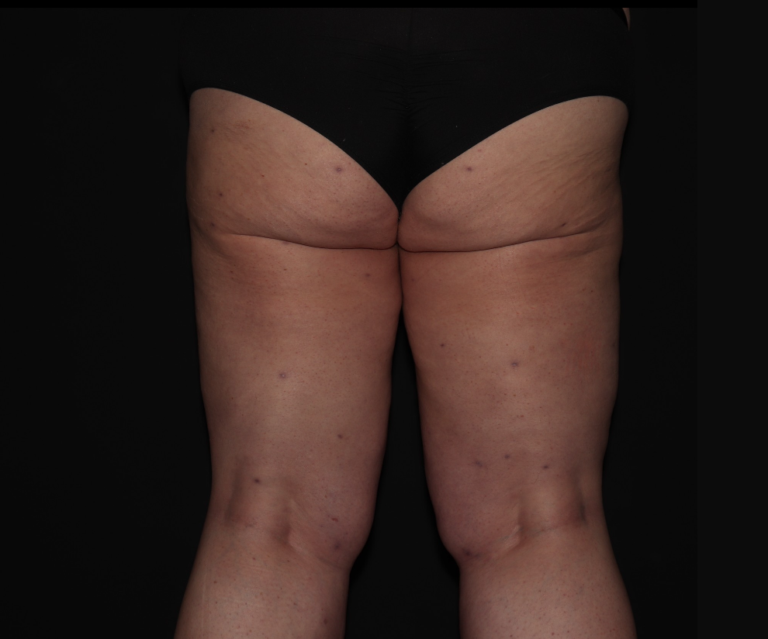 After Image: Stage 3 - back