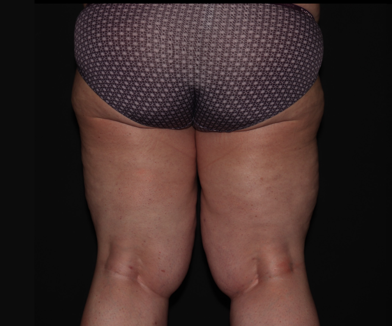 Before Image: Stage 3 - back