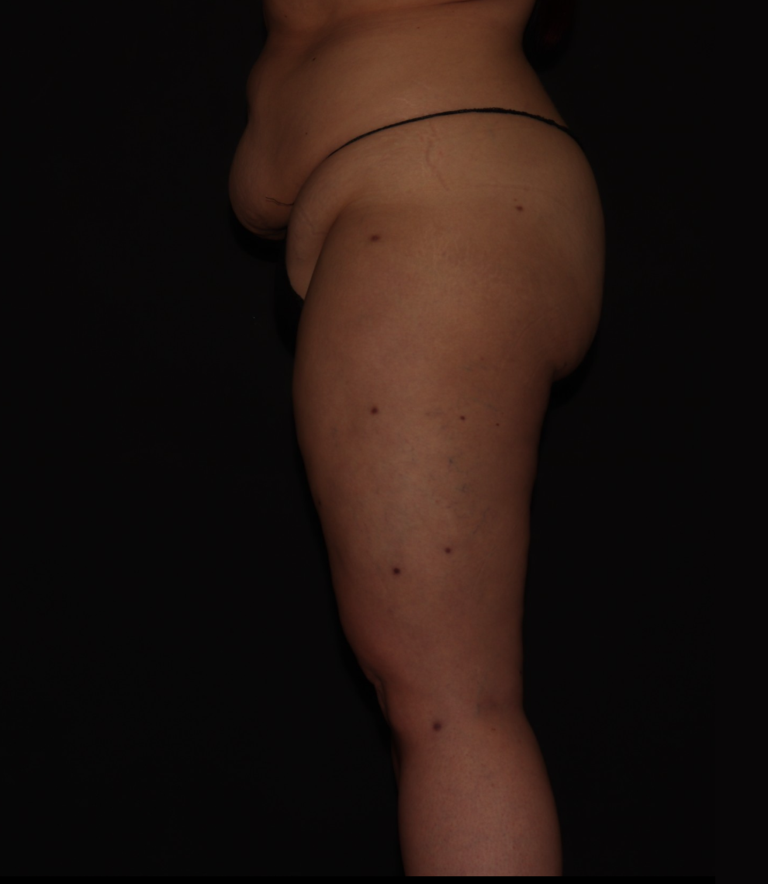 After Image: Stage 3 - left-side