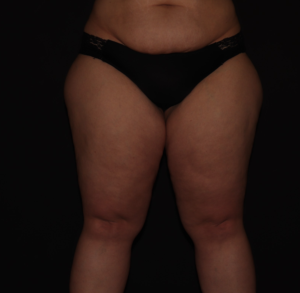 Before Image: Stage 3