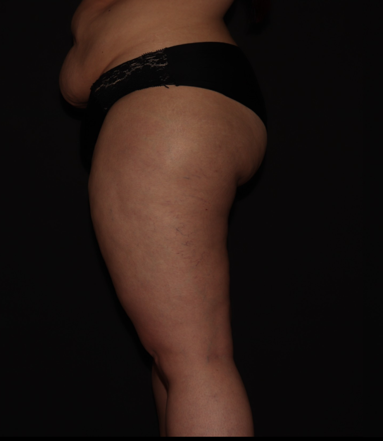 Before Image: Stage 3 - left-side