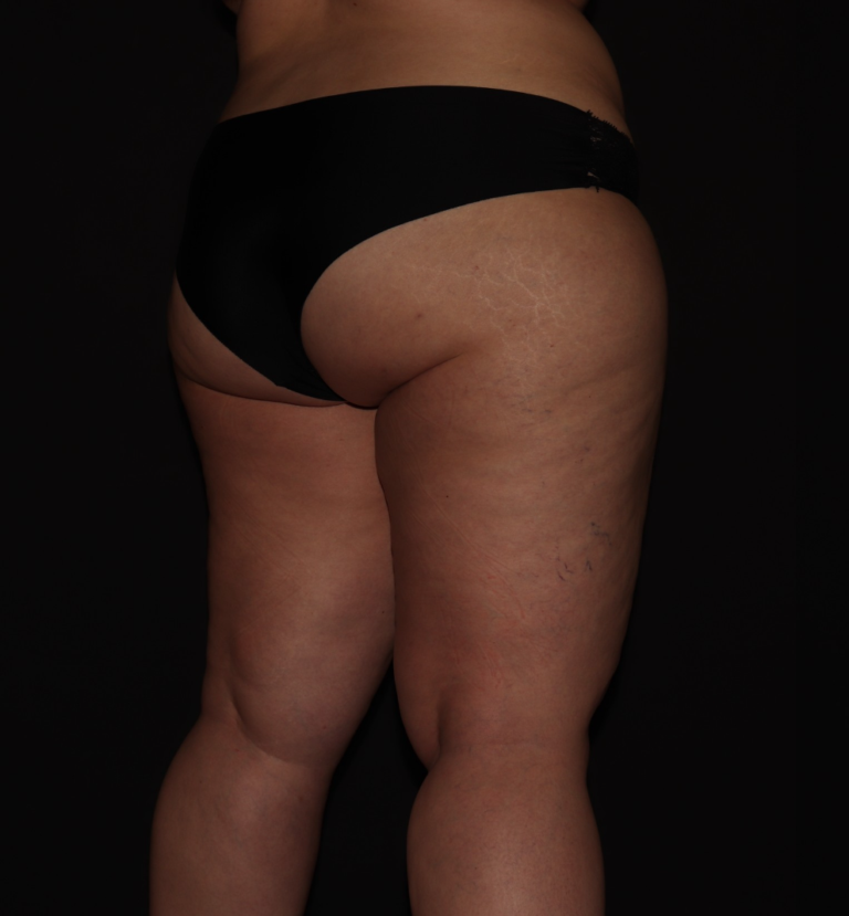 Before Image: Stage 3 - right-back-oblique