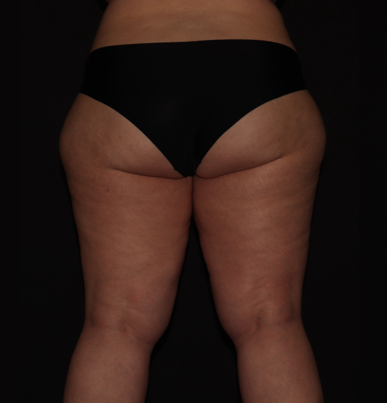 Before Image: Stage 3 - back