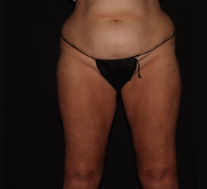 After Image: Stage 2