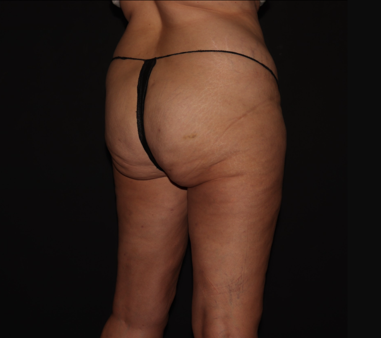 After Image: Stage 2 - right-back-oblique
