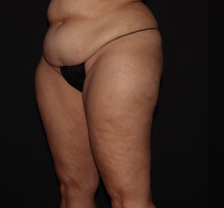 Before Image: Stage 2 - left-front-oblique