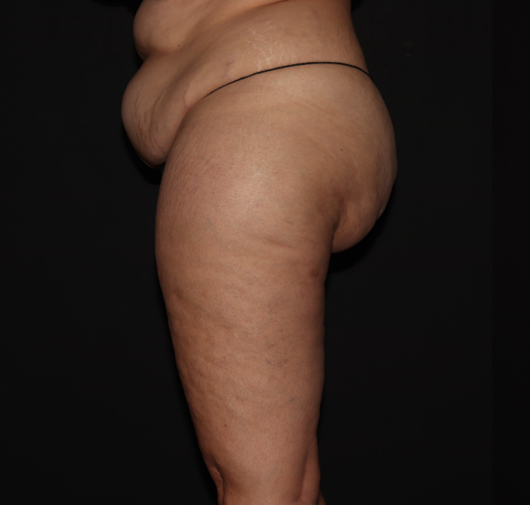 Before Image: Stage 2 - left-side