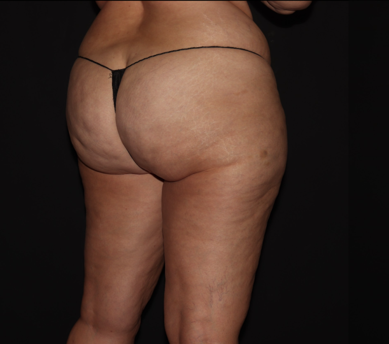 Before Image: Stage 2 - right-back-oblique