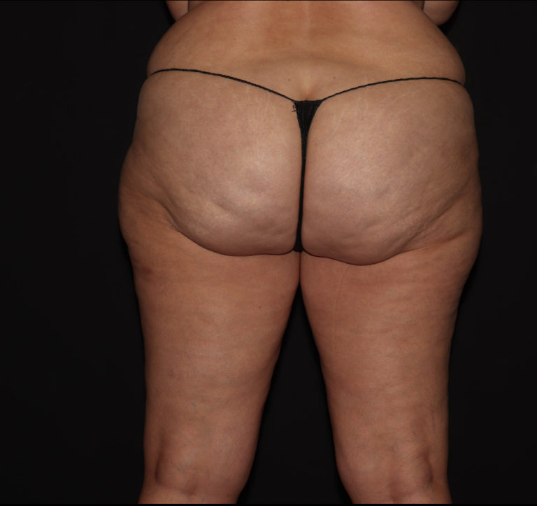Before Image: Stage 2 - back
