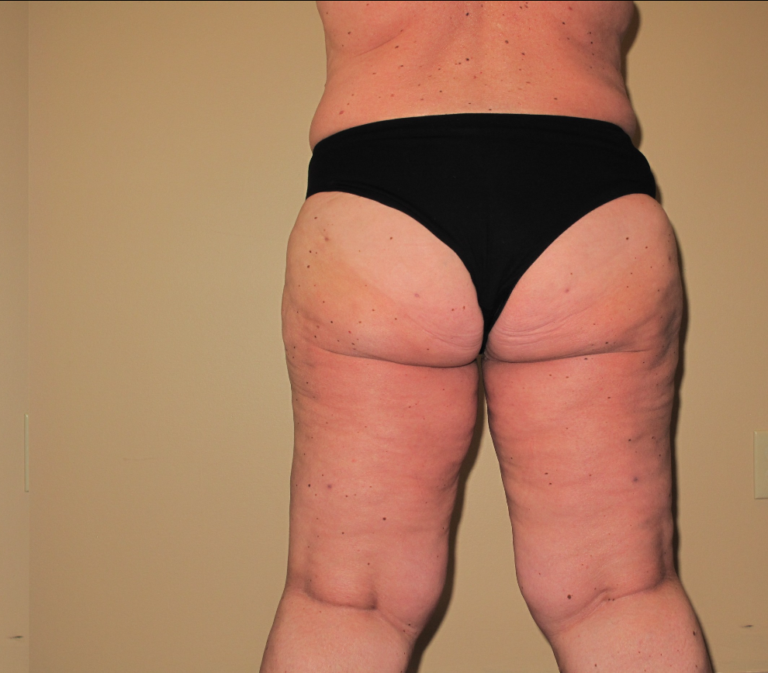 After Image: Stage 2 - back