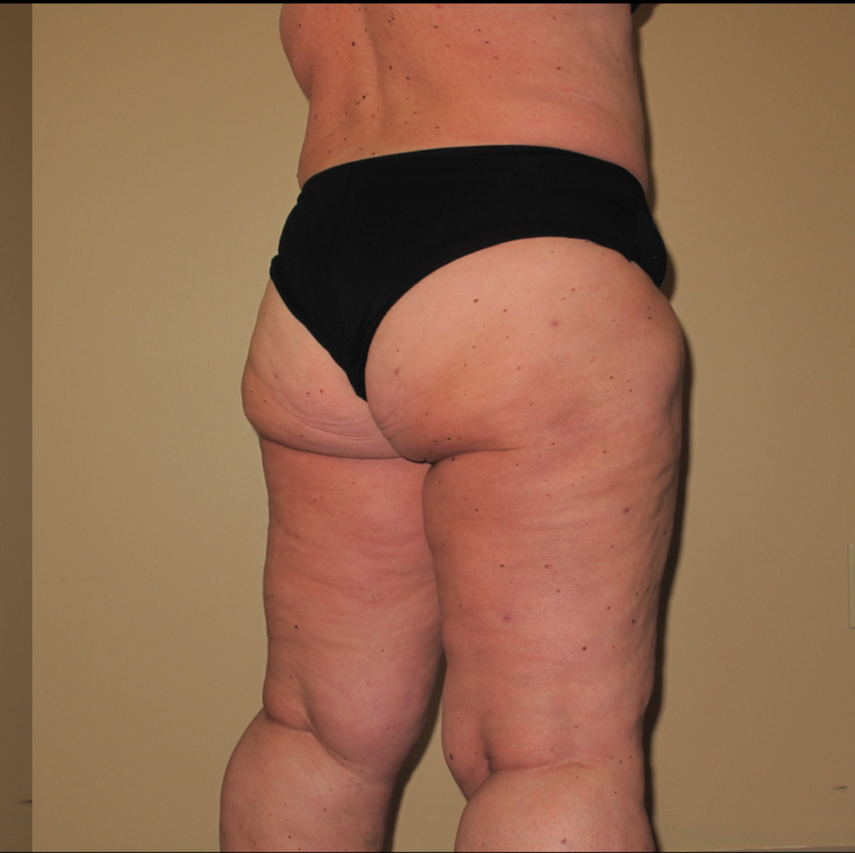 After Image: Stage 2 - right-back-oblique