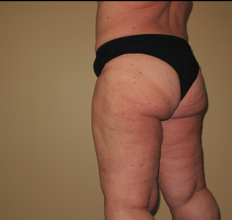 After Image: Stage 2 - left-back-oblique