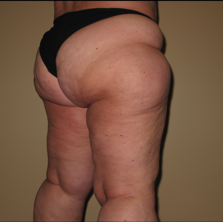 Before Image: Stage 2 - right-back-oblique