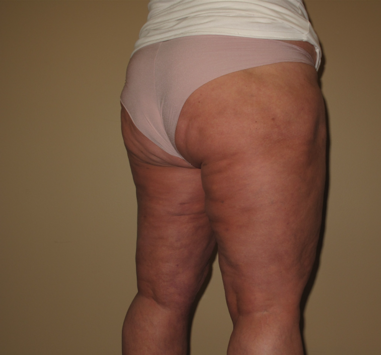 After Image: Hips and Buttocks - right-back-oblique