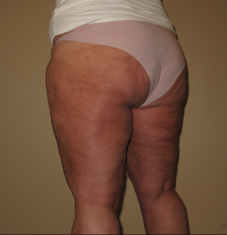 After Image: Hips and Buttocks - left-back-oblique