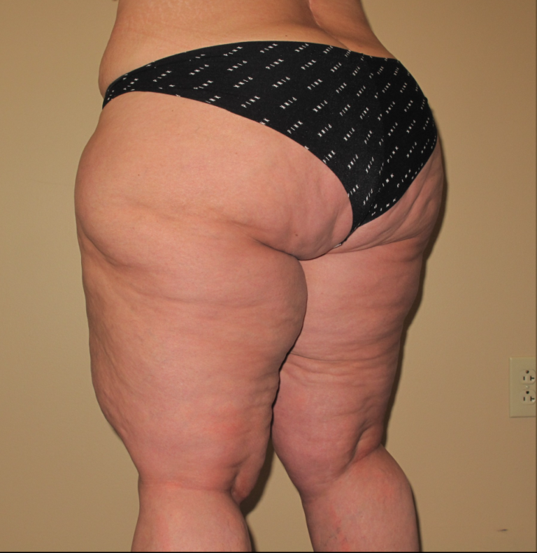 Before Image: Hips and Buttocks - left-back-oblique
