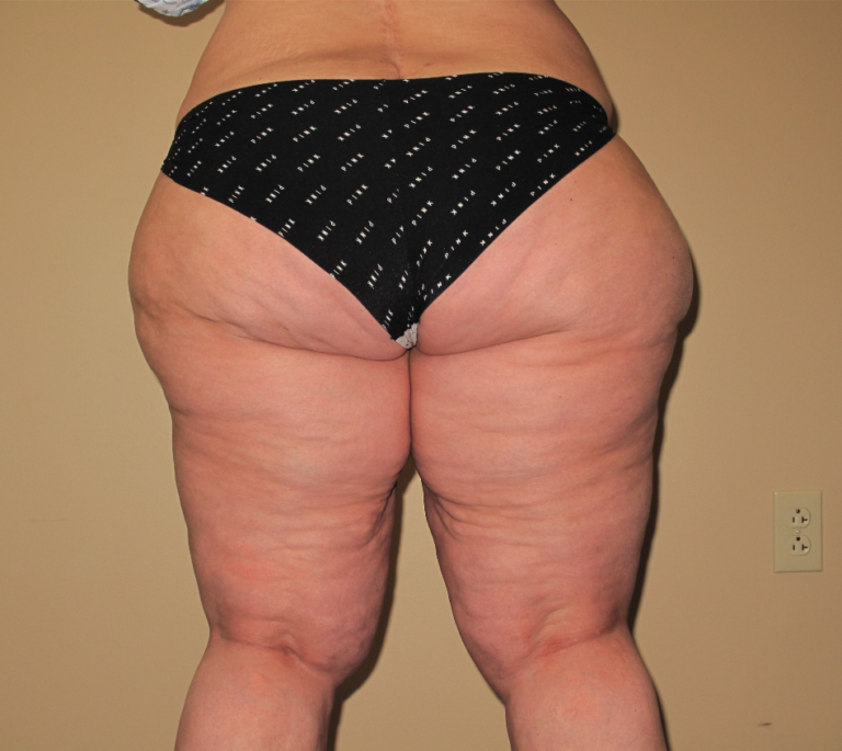 Before Image: Hips and Buttocks - back