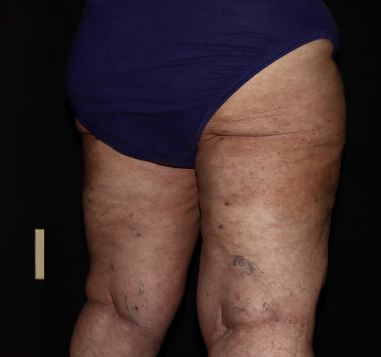 After Image: Hips and Buttocks - right-back-oblique