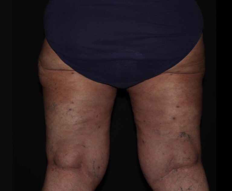 After Image: Hips and Buttocks - back