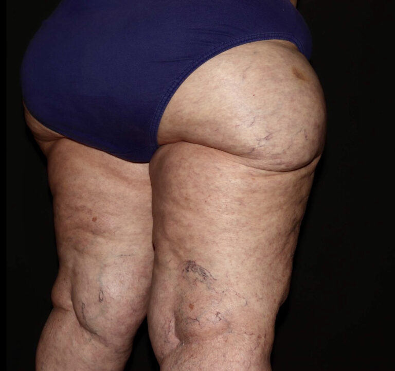 Before Image: Hips and Buttocks - right-back-oblique