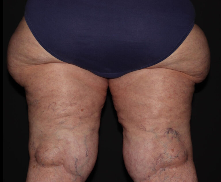 Before Image: Hips and Buttocks - back
