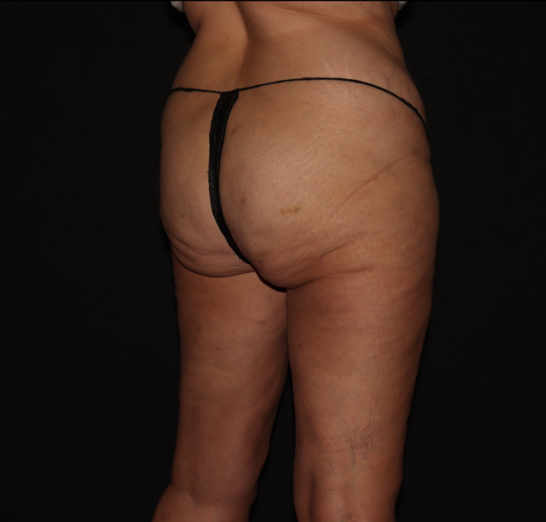 After Image: Hips and Buttocks - right-back-oblique