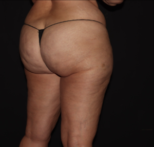 Before Image: Hips and Buttocks