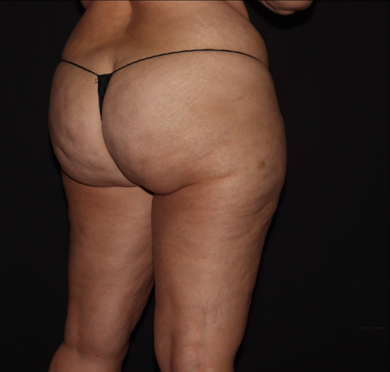 Before Image: Hips and Buttocks - right-back-oblique
