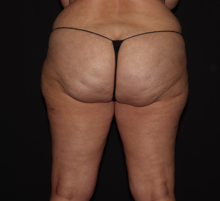 Before Image: Hips and Buttocks - back