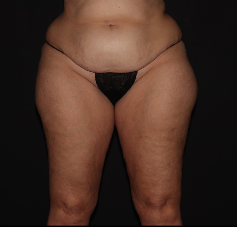 Before Image: Hips and Buttocks - front