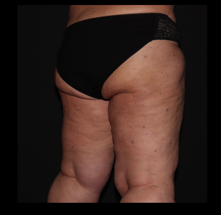 After Image: Hips and Buttocks - right-back-oblique